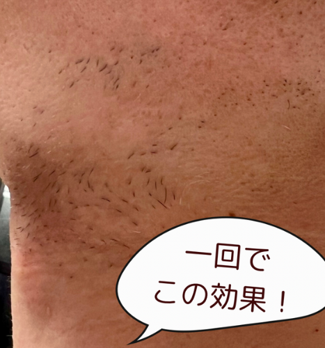 MEN'Sヒゲ脱毛